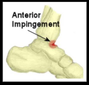 Ask The Physio What Is Anterior Ankle Impingement Dance Life